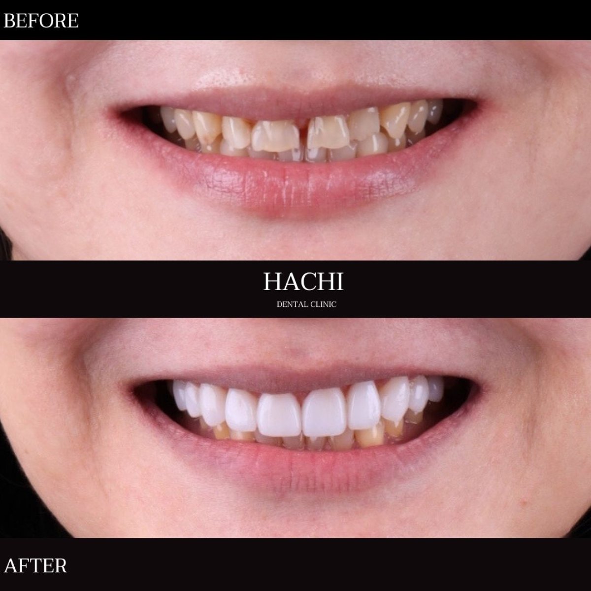 Porcelain veneer before and after results at Hachi Dental Clinic & Digital Veneer Lab, smile makeover