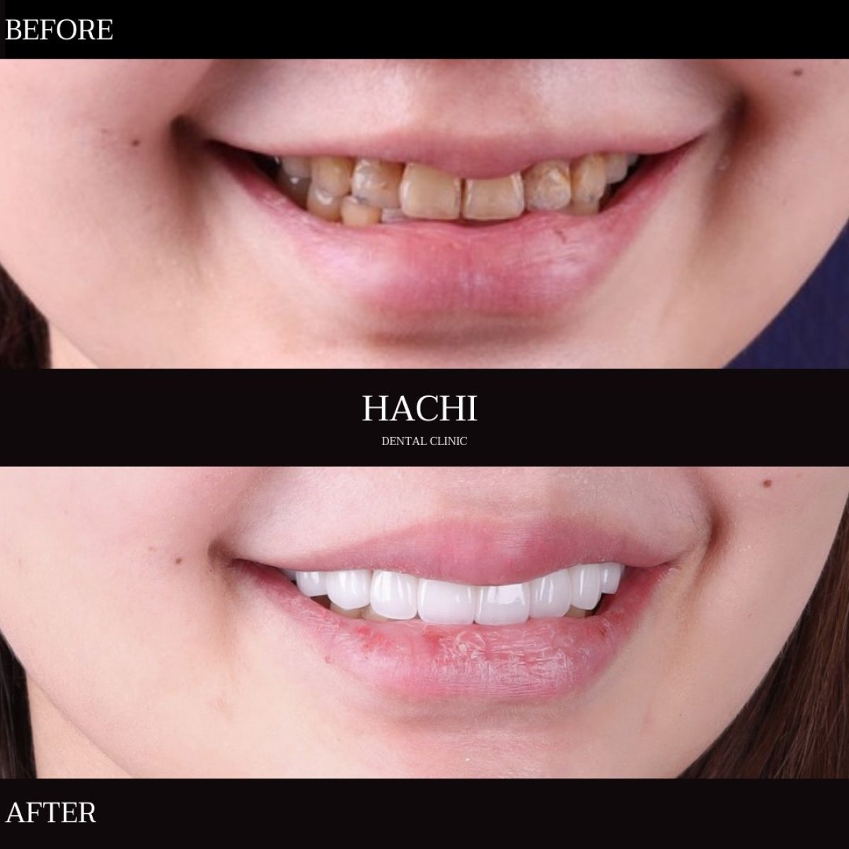 Resultados antes y después de carillas de porcelana en Hachi Dental Clinic & Digital Veneer Lab