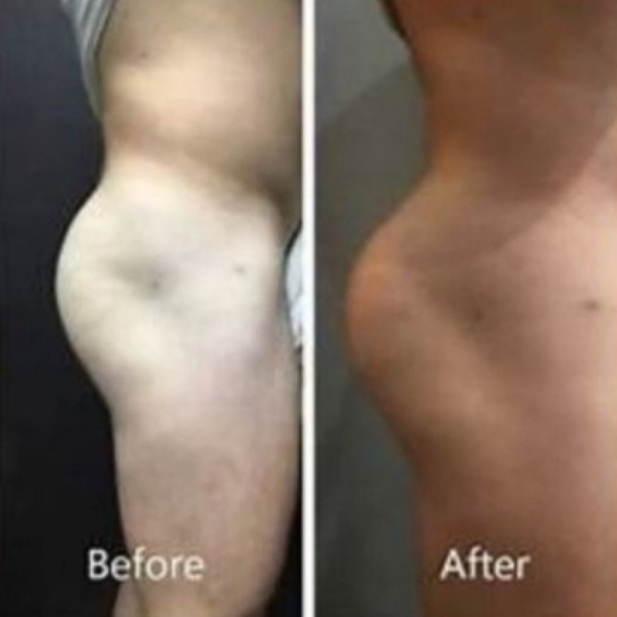 Before and after butt implants at ID Clinic Bangkok, enhanced gluteal contour result