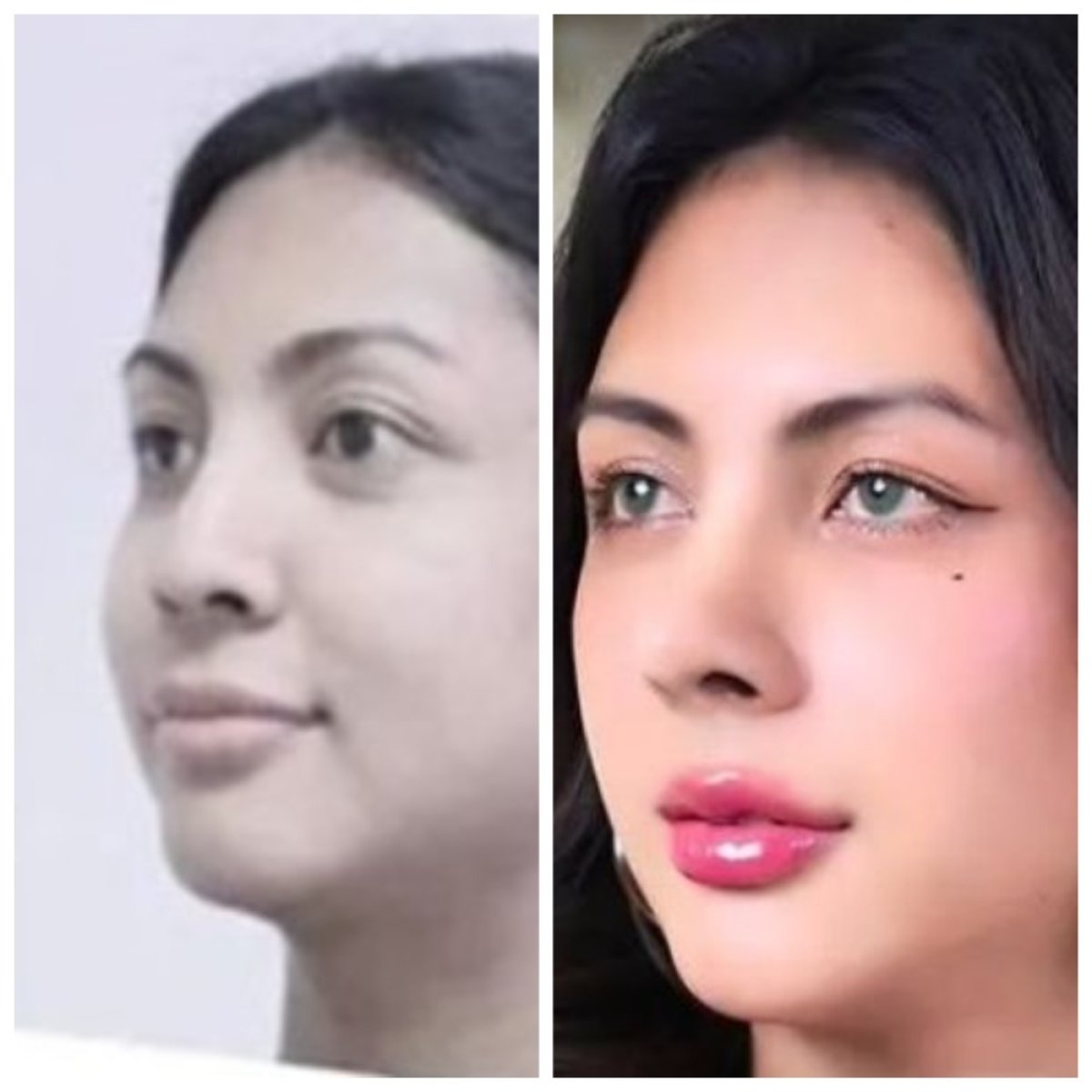 Before and after tip rhinoplasty results at Asia Cosmetic Hospital, refined nose shape