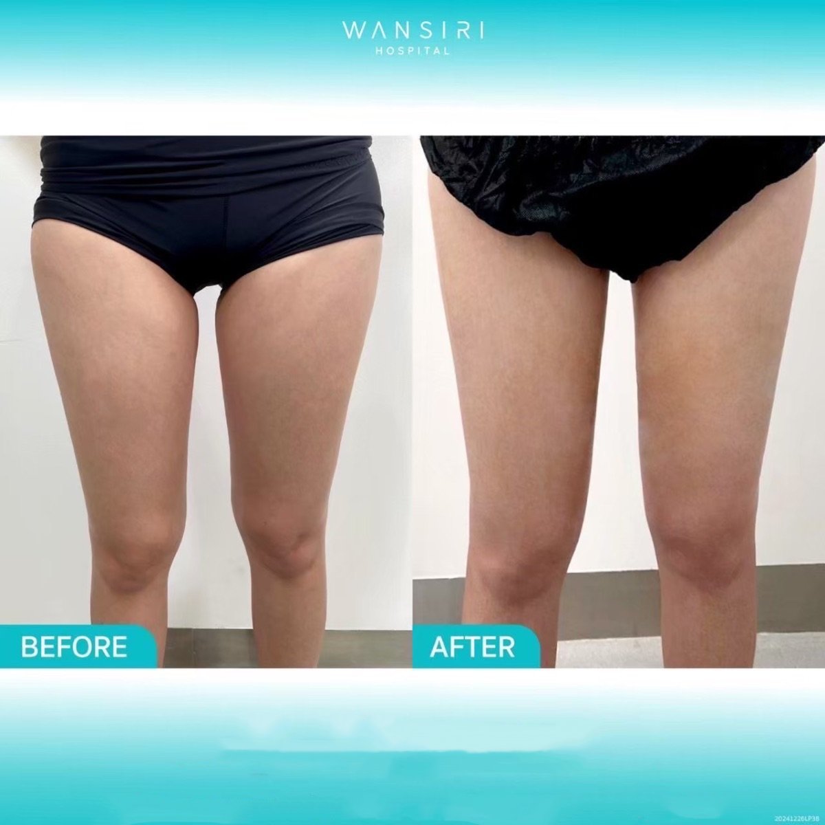 Before and after liposuction results at Wansiri Hospital, slimmer thighs and improved contour
