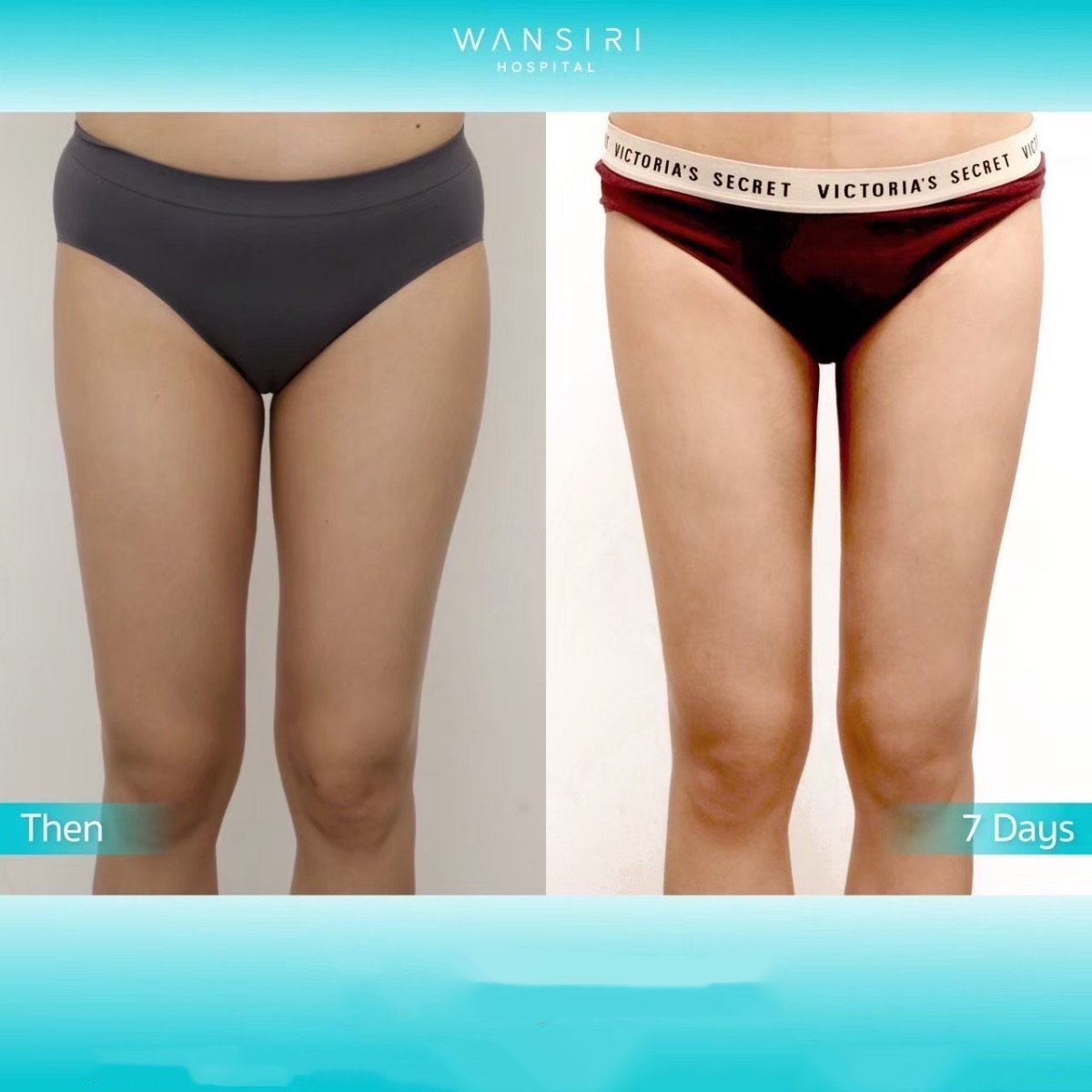 Before and after liposuction results at Wansiri Hospital, slimmer thighs after 7 days
