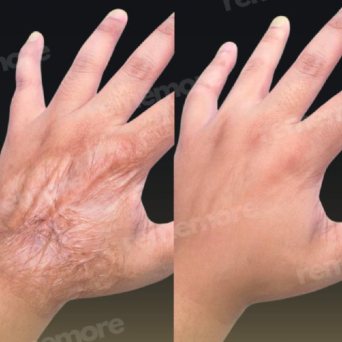 Antes y después de la revisión de cicatrices en la mano en Memorial Bahçelievler Hospital, resultado visible