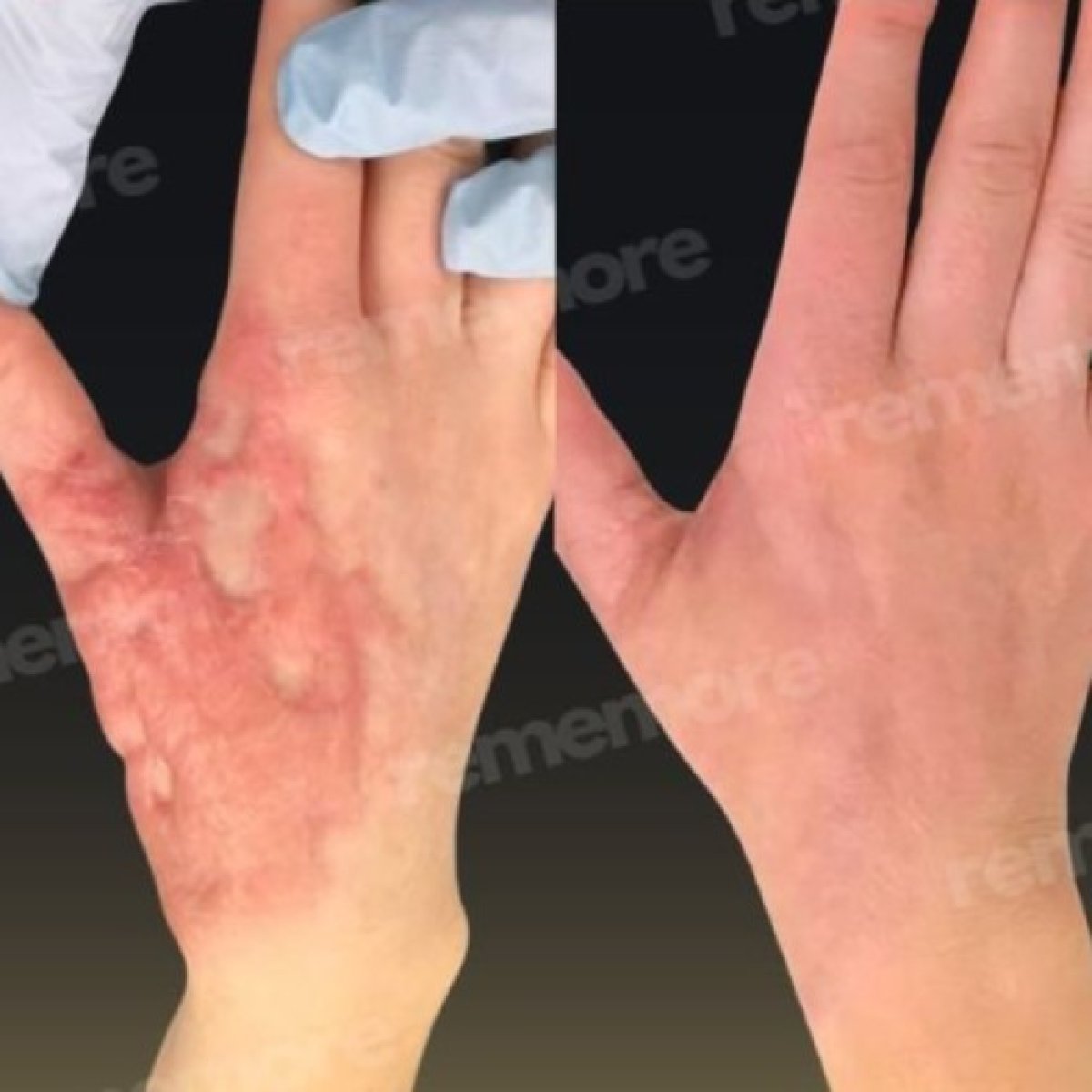 Scar revision before and after results on hand at Memorial Bahçelievler Hospital, smoother skin