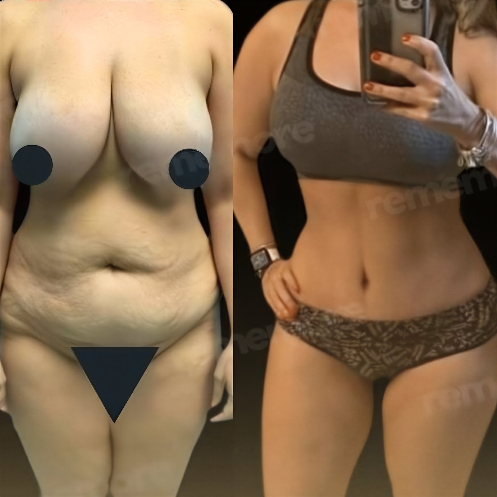Resultados antes y después de liposucción Vaser en Memorial Antalya Hospital, mejor contorno corporal