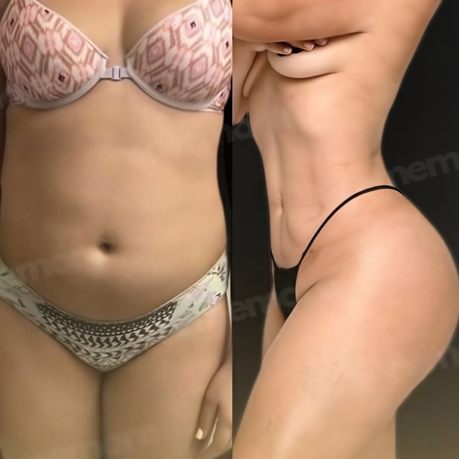 Resultados antes y después de liposucción Vaser en Memorial Antalya Hospital, mejora corporal