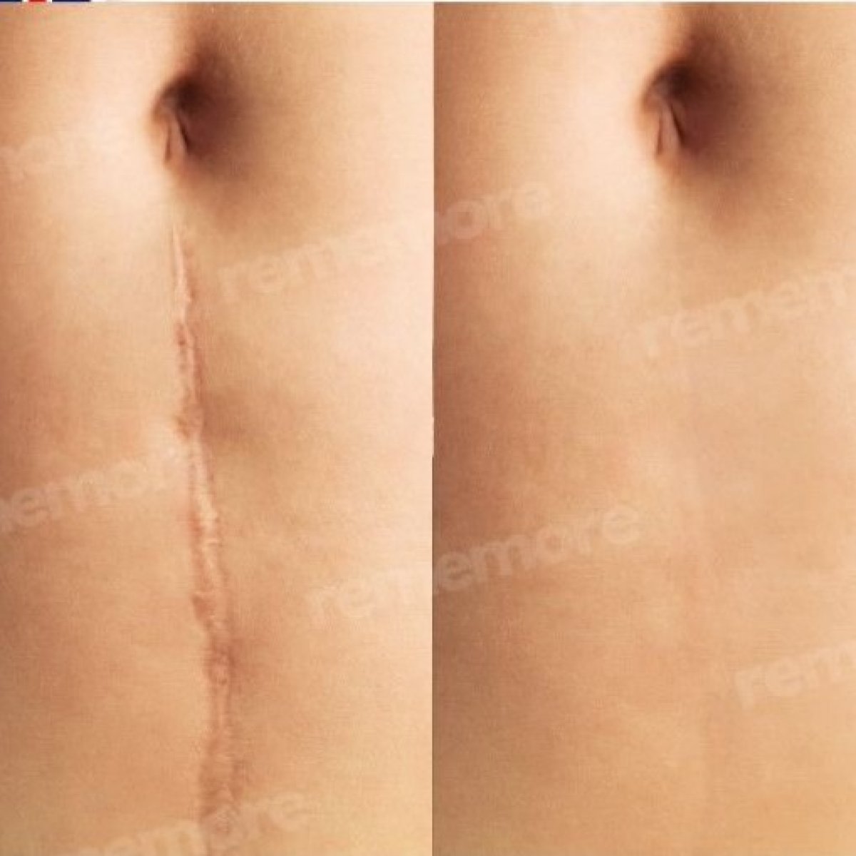 Résultats avant/après révision de cicatrice à Memorial Antalya Hospital, cicatrice abdominale améliorée