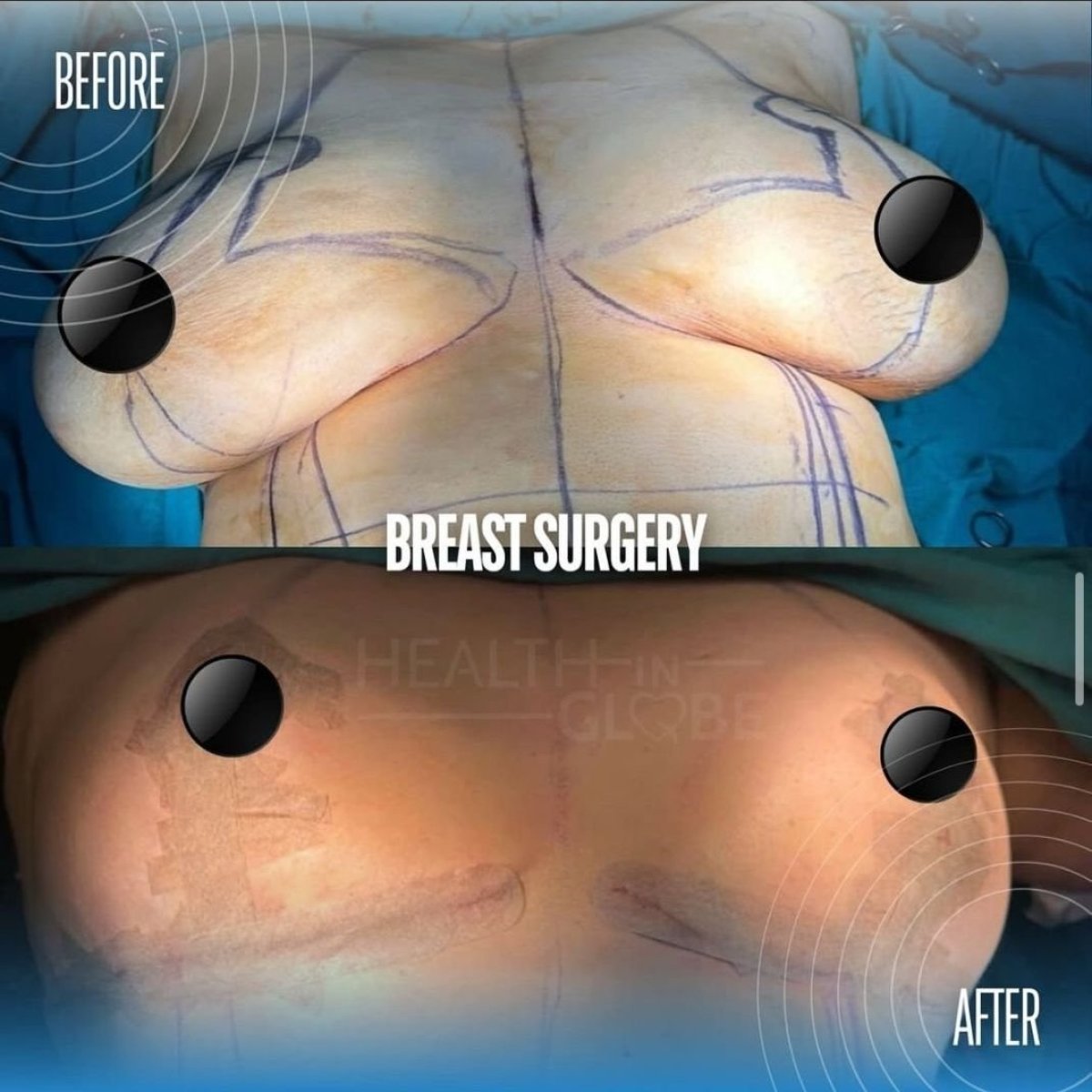 Before and after breast augmentation results at Memorial Şişli Hospital, improved breast shape