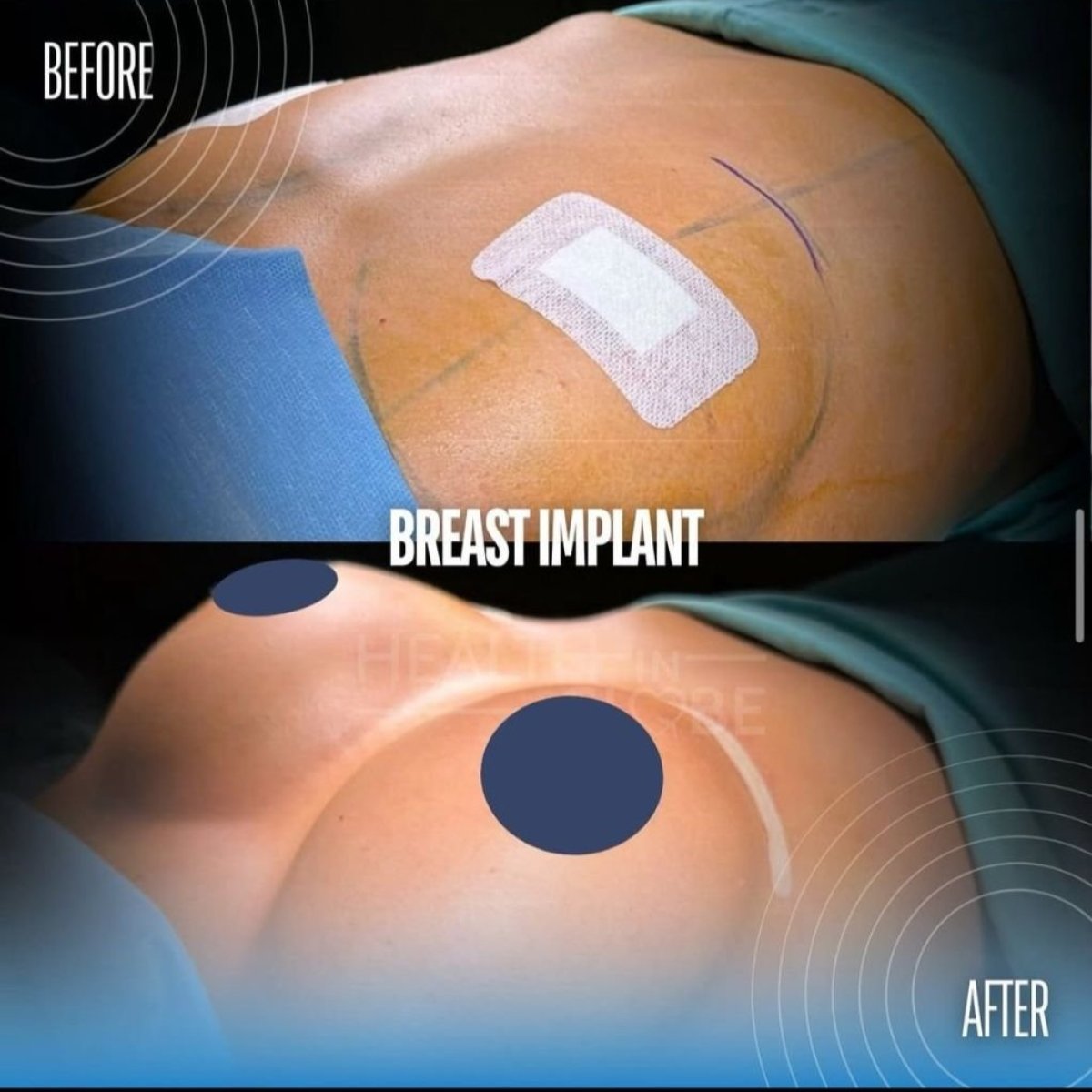 Before and after breast augmentation results at Memorial Şişli Hospital, enhanced breast shape