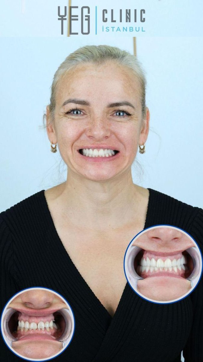 Résultats avant/après facettes en porcelaine à YEG Clinic – sourire plus blanc