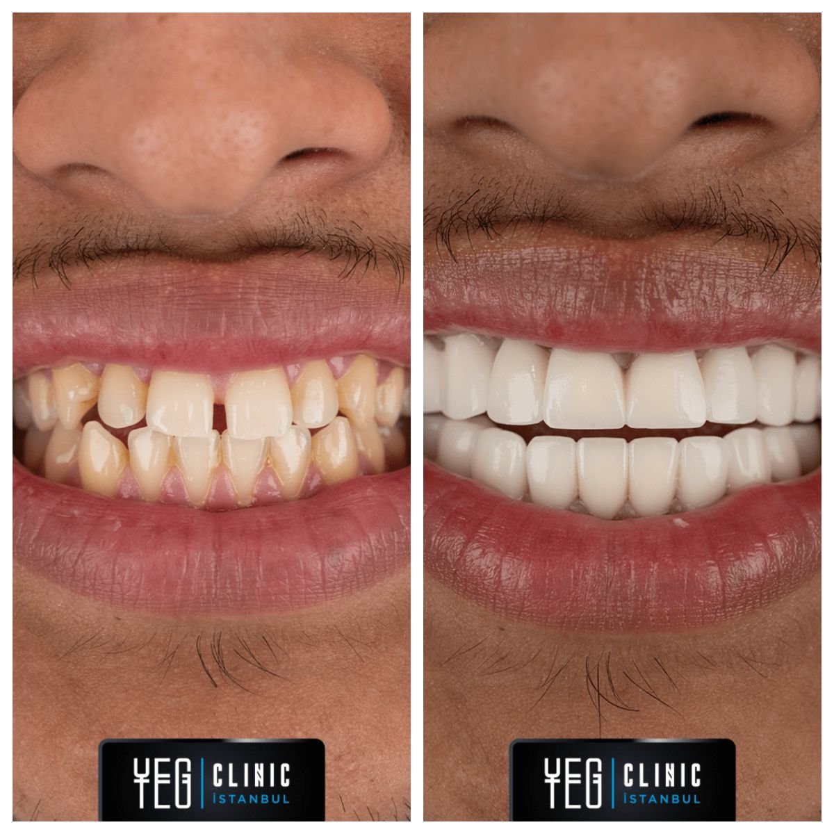 Resultados antes y después de carillas de porcelana en YEG Clinic – sonrisa mejorada