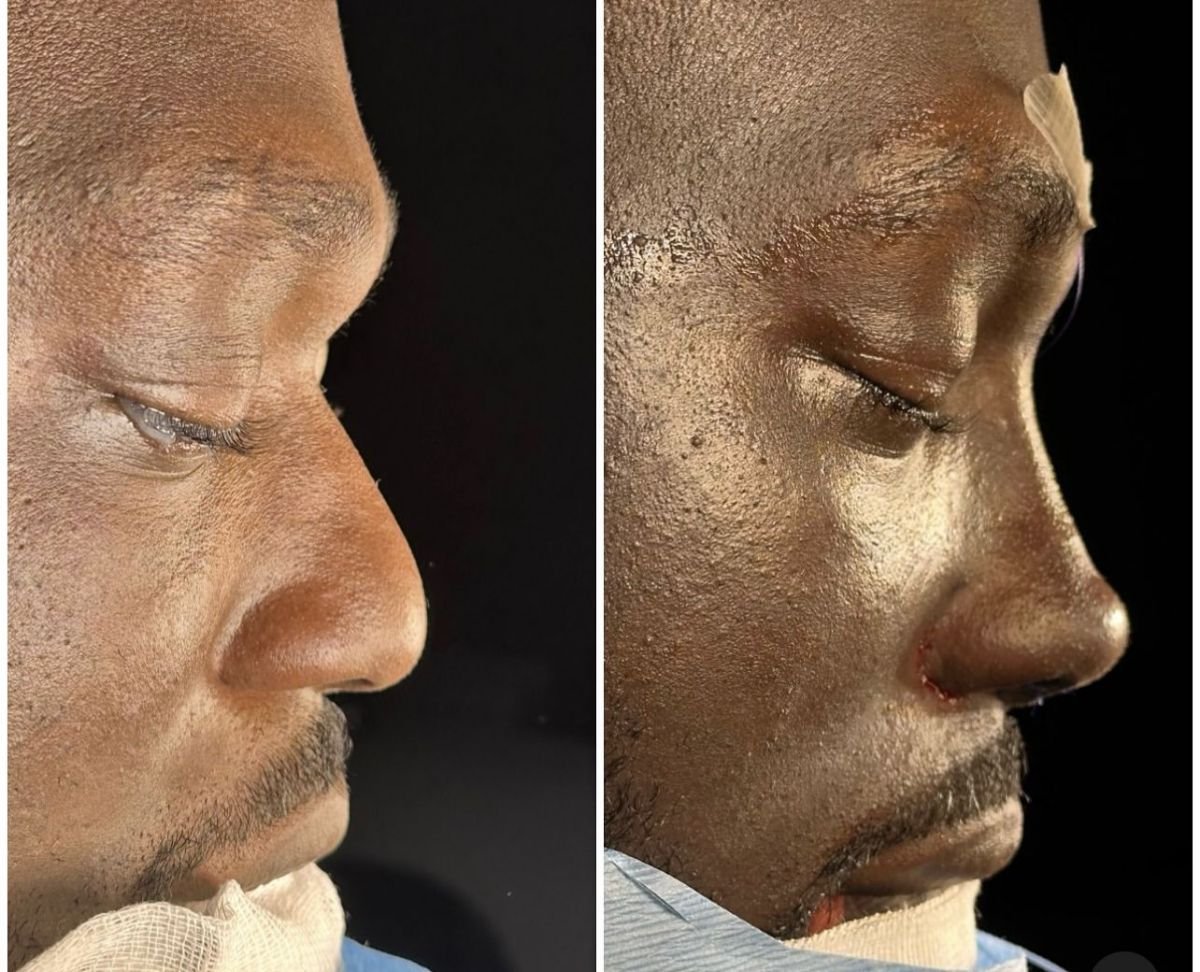 نتائج تجميل الأنف قبل وبعد في مستشفى لوكمان حكيم إسطنبول، تحسين شكل الأنف