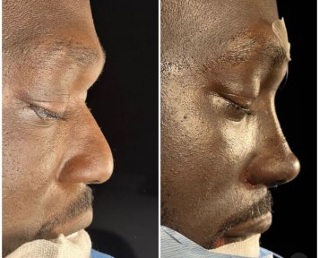 Premium Rhinoplasty (nose job) All Included - photo 4
