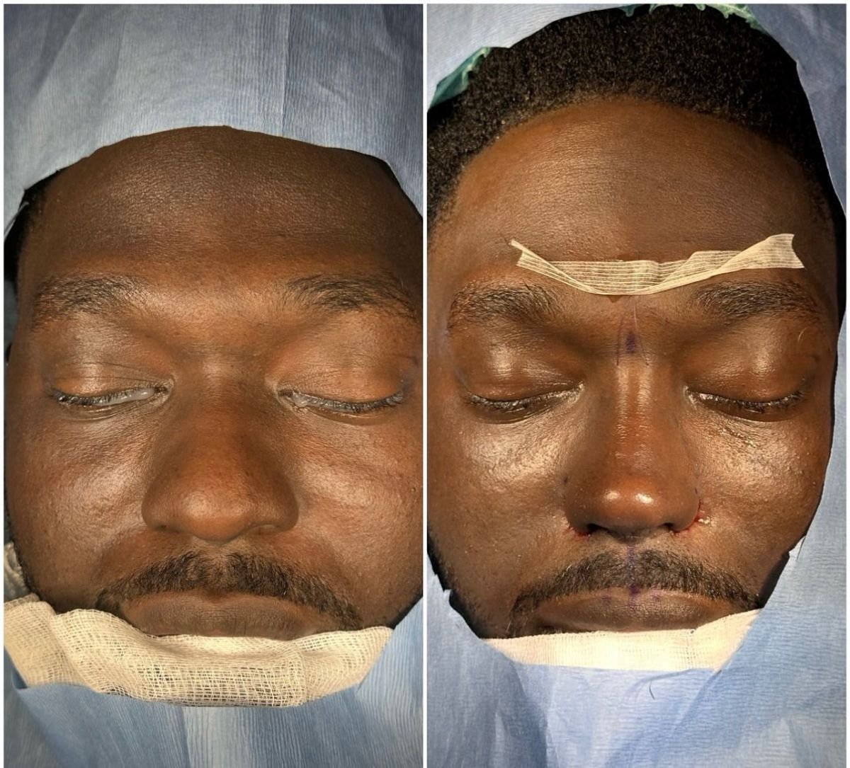 Resultados de rinoplastia antes y después en Lokman Hekim Istanbul Hospital, remodelación nasal