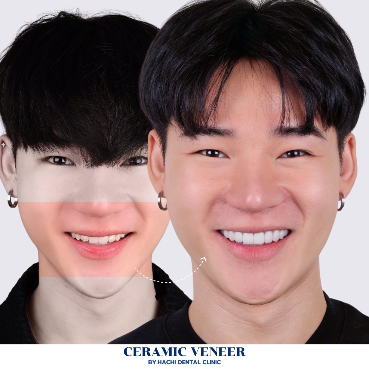 Resultado antes y después de carillas cerámicas en Hachi Dental Clinic, sonrisa mejorada