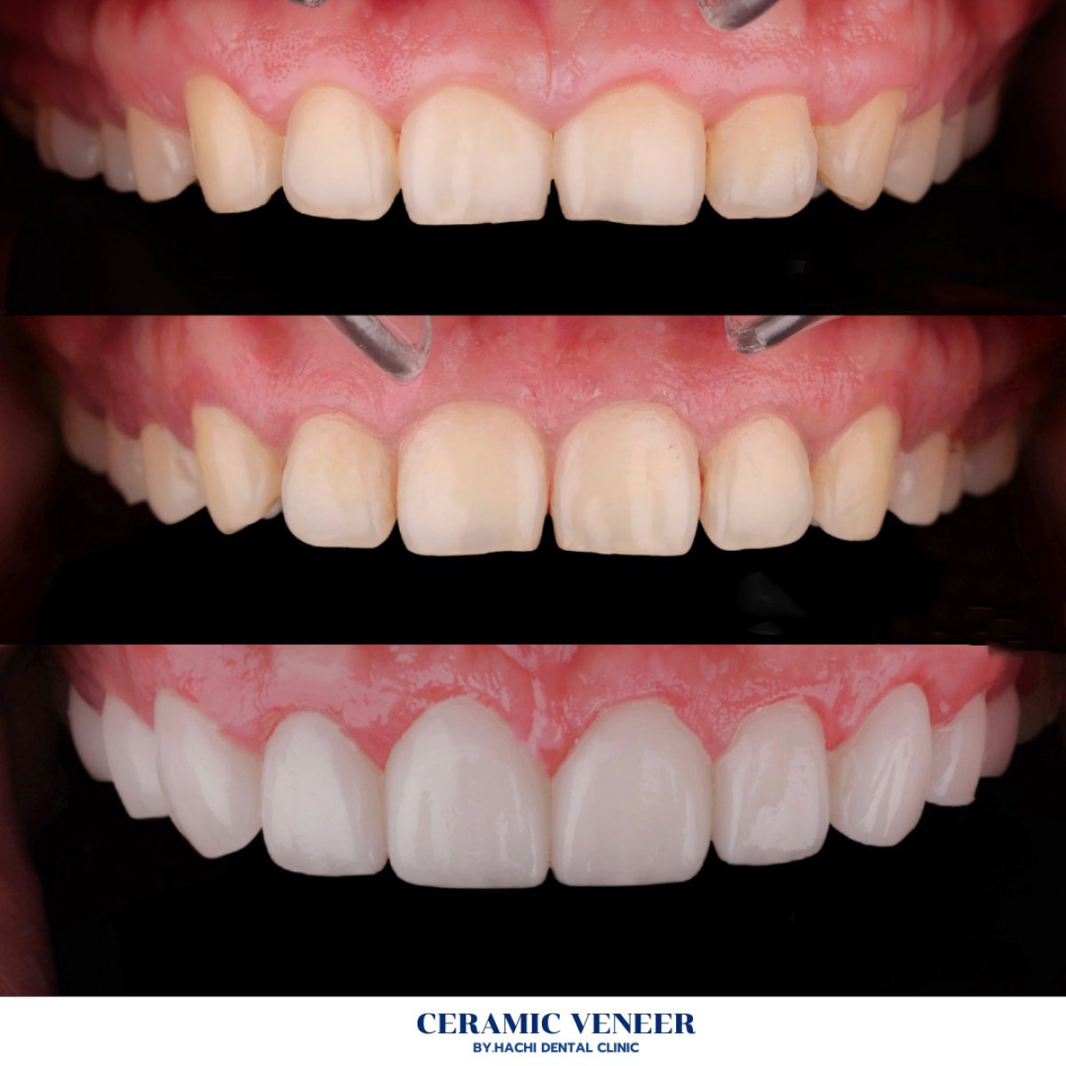 Antes y después de carillas cerámicas en Hachi Dental Clinic, resultado de sonrisa