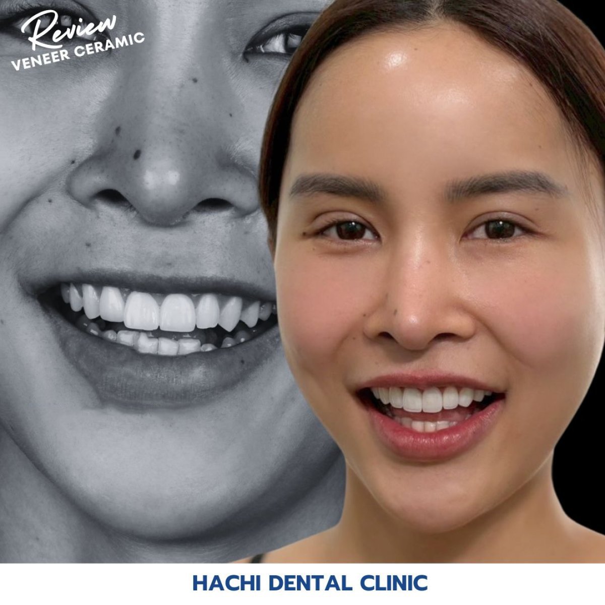 نتائج قبل وبعد عدسات الأسنان الخزفية في Hachi Dental Clinic، تحول ملحوظ للابتسامة