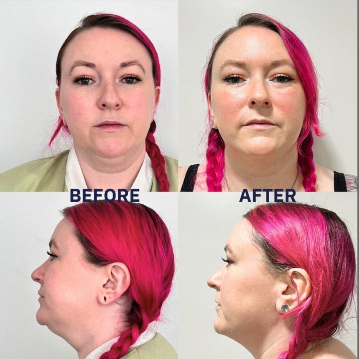 Before and after Vaser liposuction results at ID Clinic Bangkok, improved jawline contour