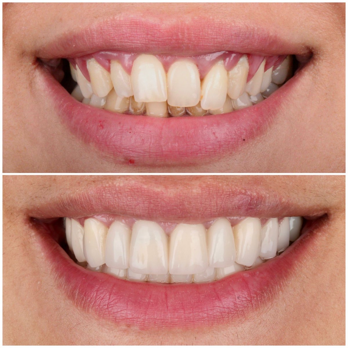 Результаты до и после установки зубных коронок в Dentlotus Clinic, улучшение улыбки