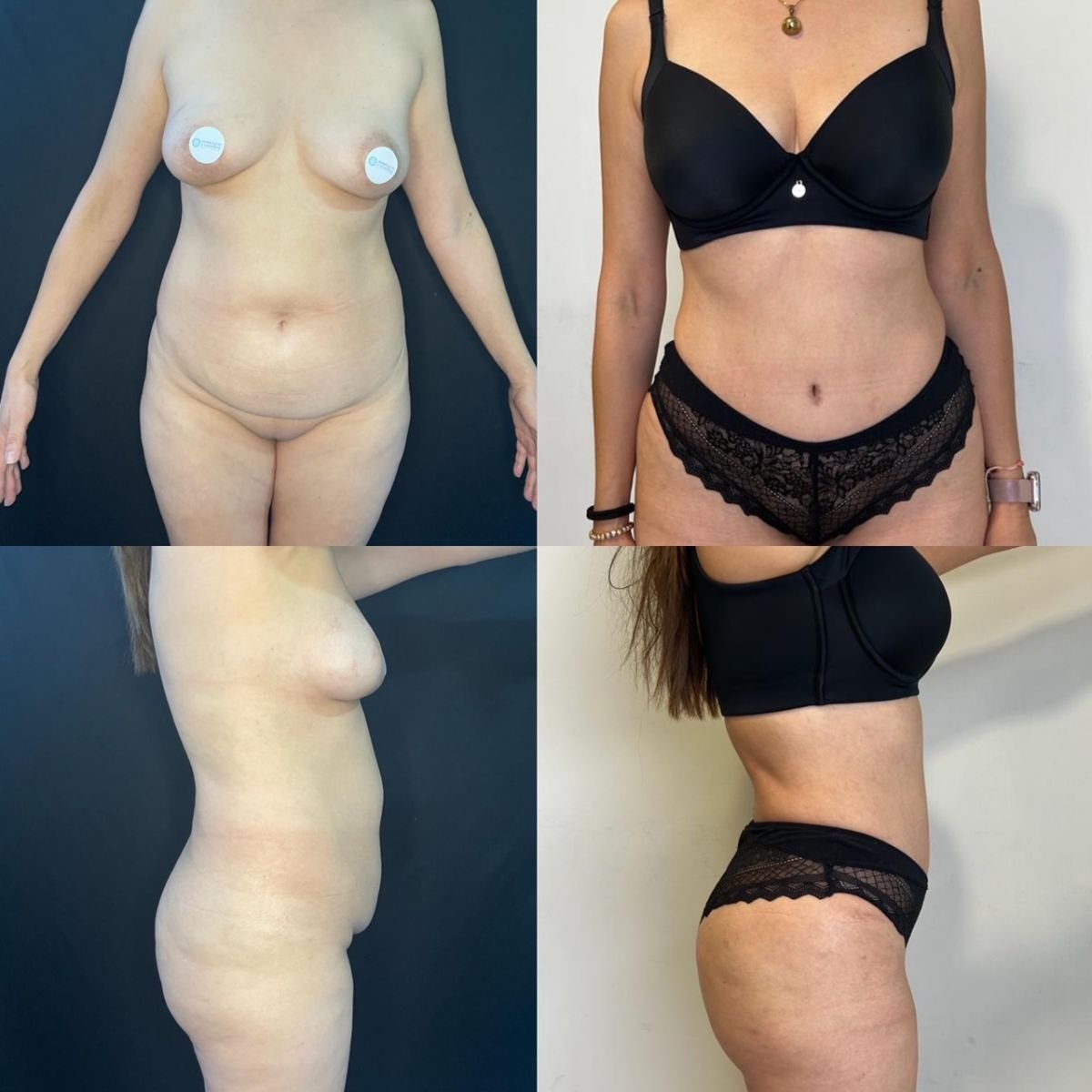 نتائج شد الثدي قبل وبعد في عيادة Marroquín & Sandoval لجراحة التجميل، تحسين الشكل