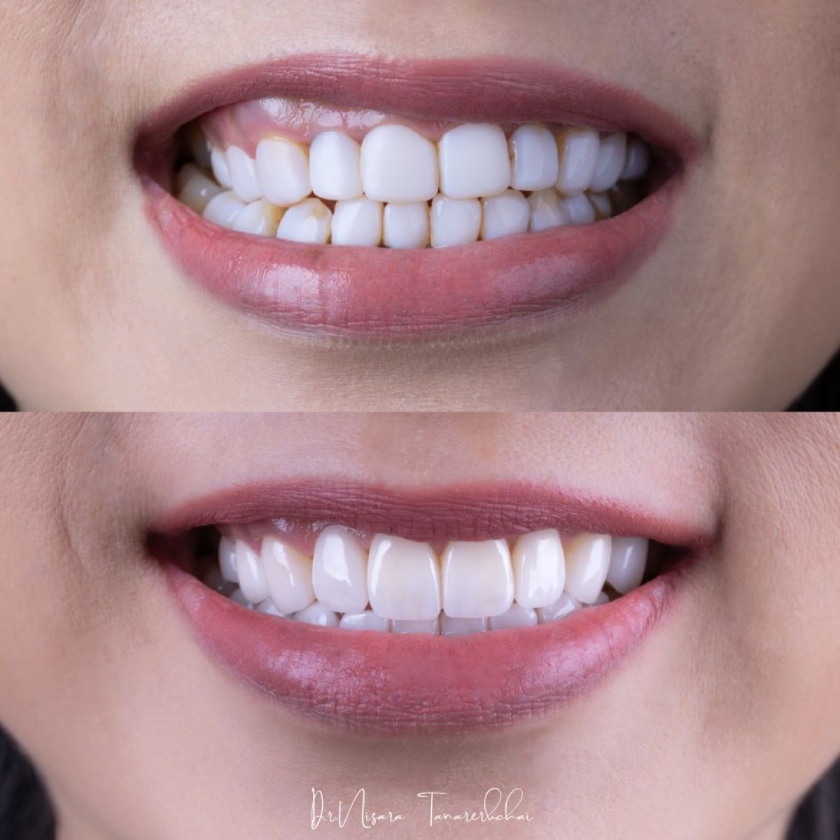 Résultats avant et après facettes en porcelaine à About Tooth Dental Clinic, transformation du sourire