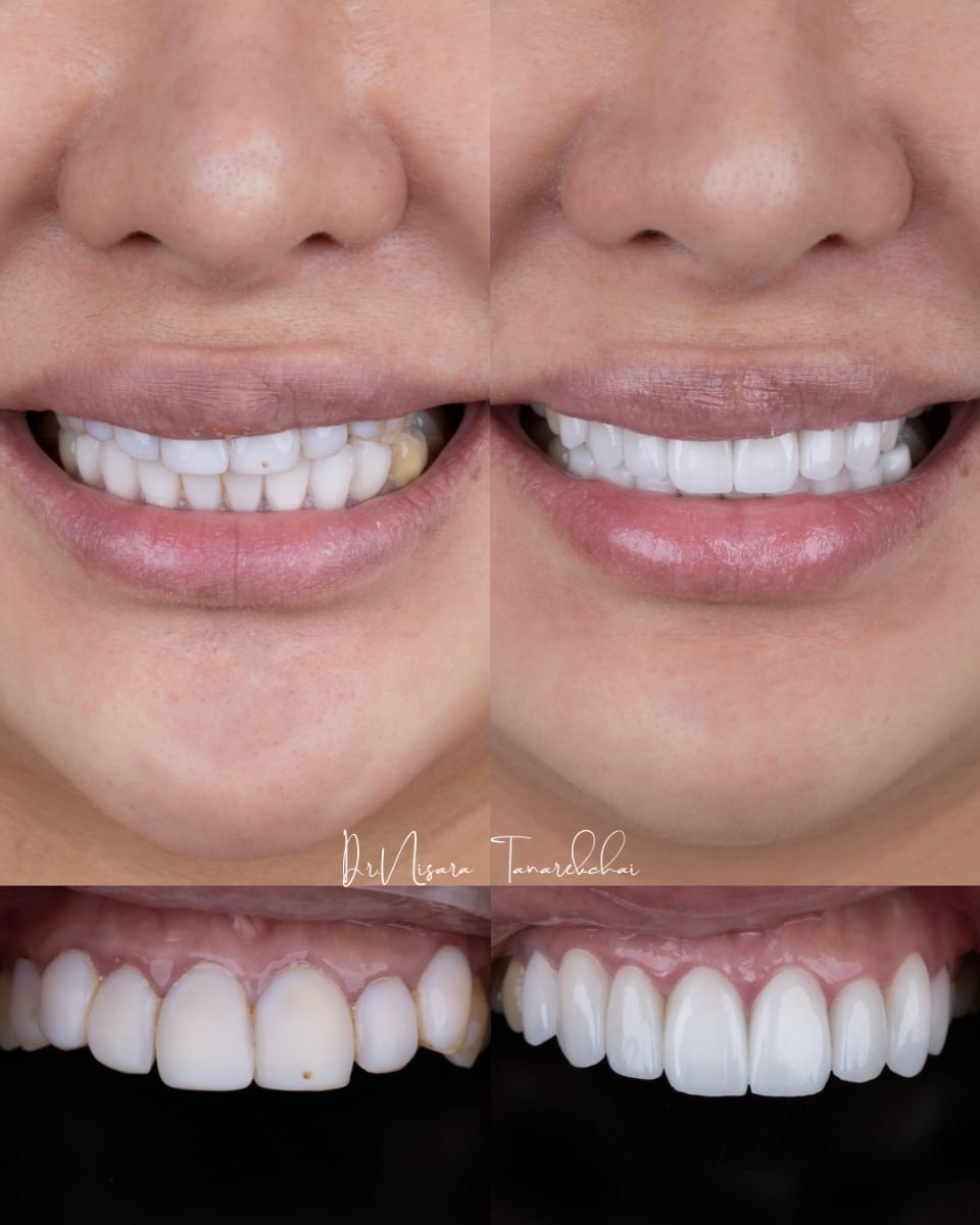 Resultados antes y después de carillas de porcelana en About Tooth Dental Clinic, transformación de sonrisa