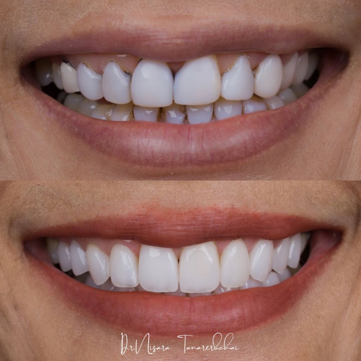 Résultats avant et après facettes en porcelaine chez About Tooth Dental Clinic, sourire transformé