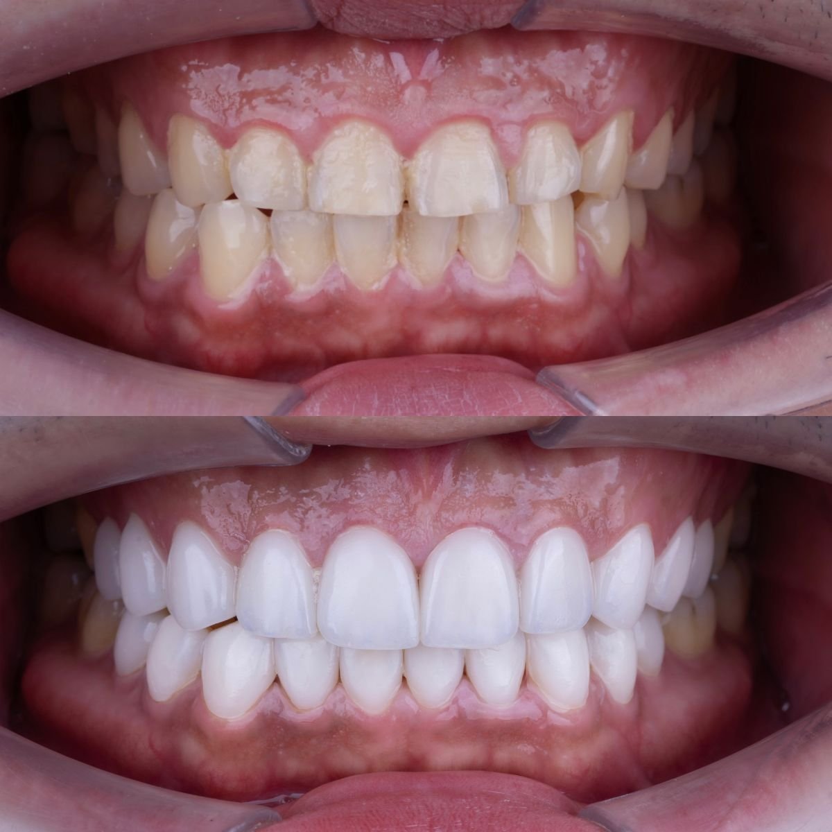 Before and after porcelain veneer results at About Tooth Dental Clinic, smile transformation