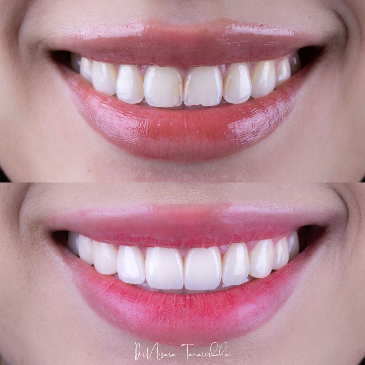 نتائج قبل وبعد عدسات الأسنان الخزفية في About Tooth Dental Clinic، تجميل الابتسامة