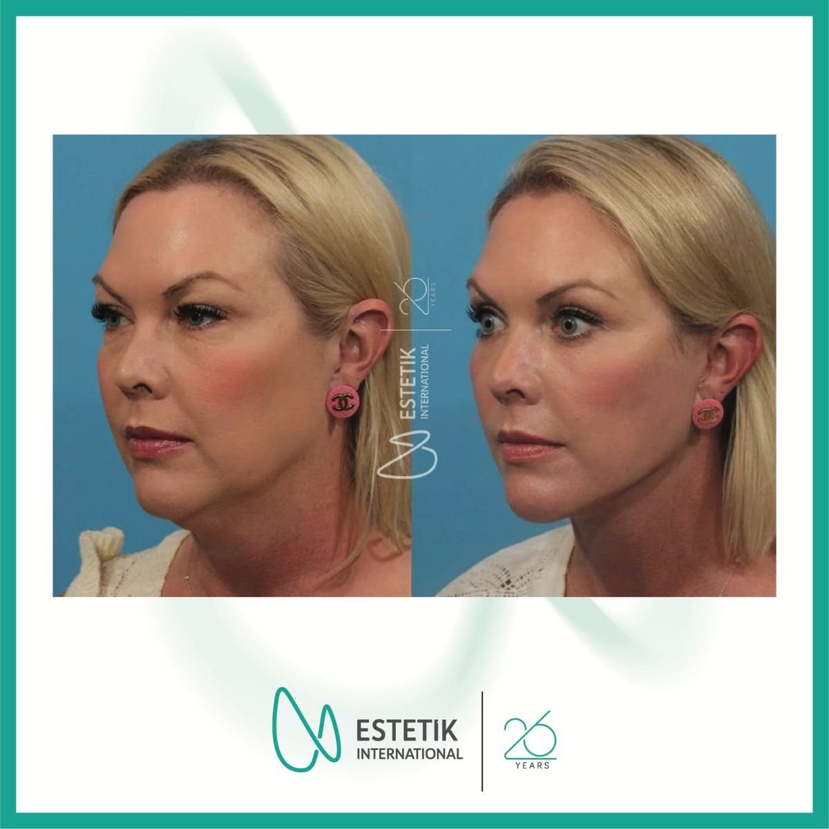 Facelift before and after results at Estetik International Istanbul, visible facial rejuvenation