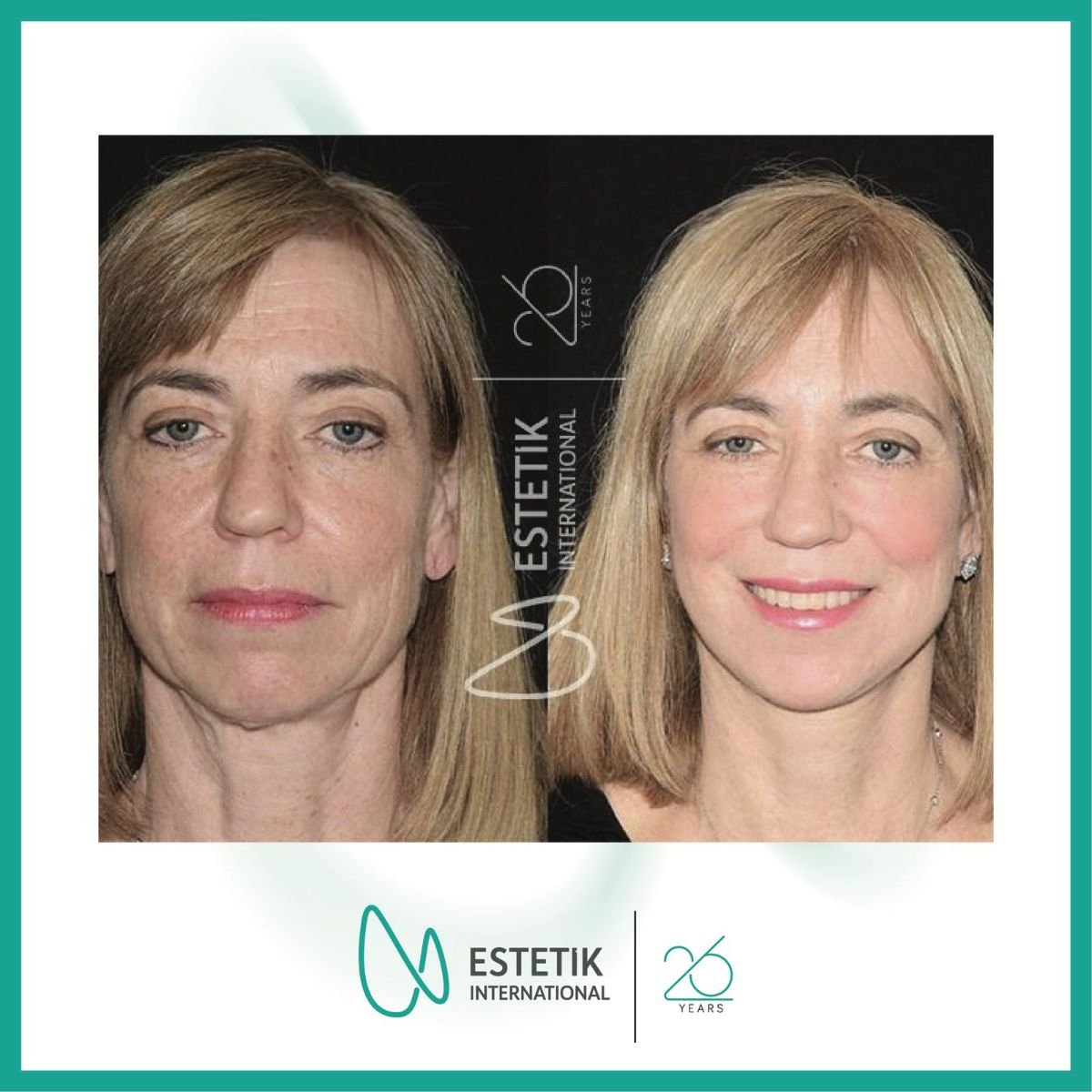 Facelift before and after results at Estetik International Istanbul, visible facial rejuvenation