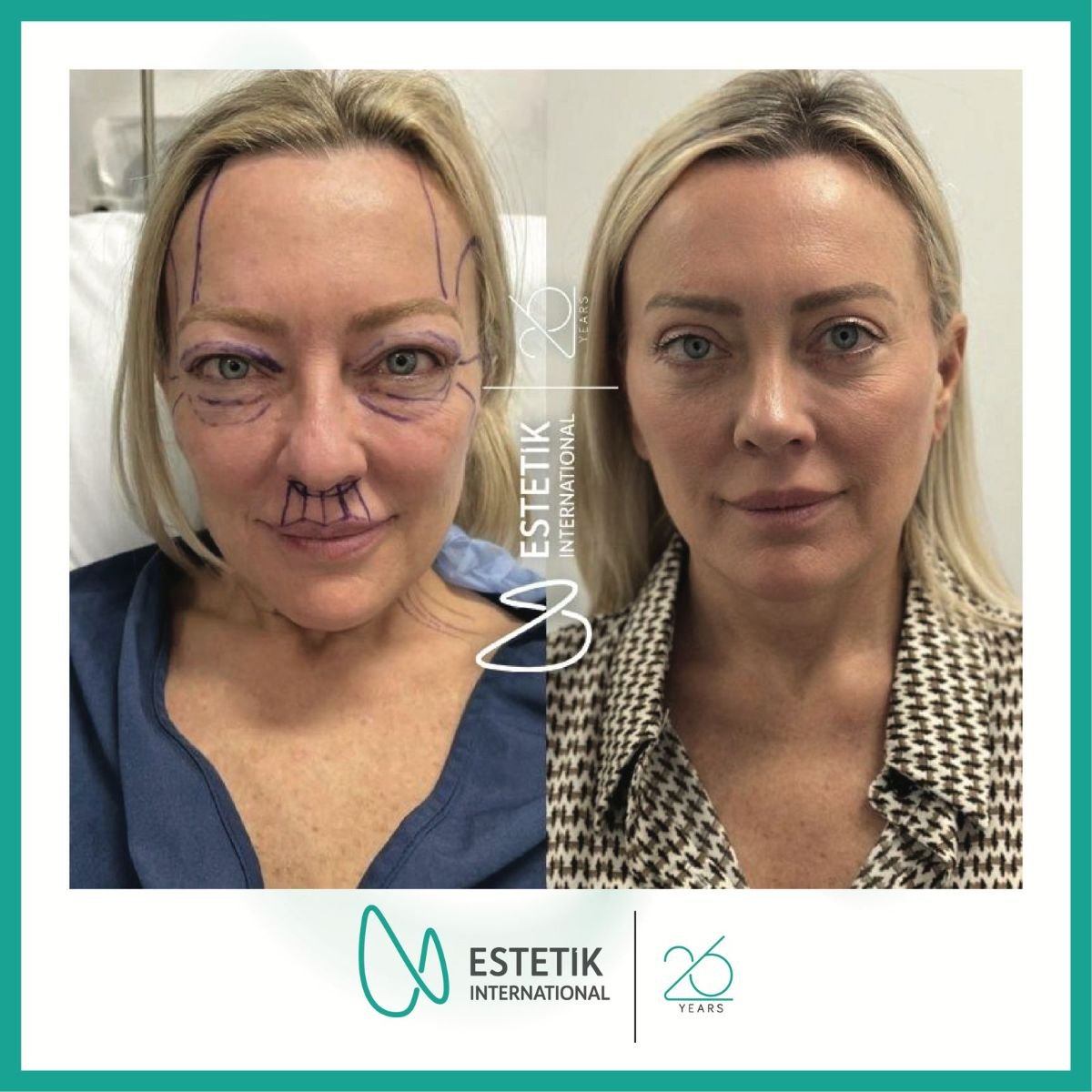 Before and after facelift results at Estetik International Istanbul, visible facial rejuvenation