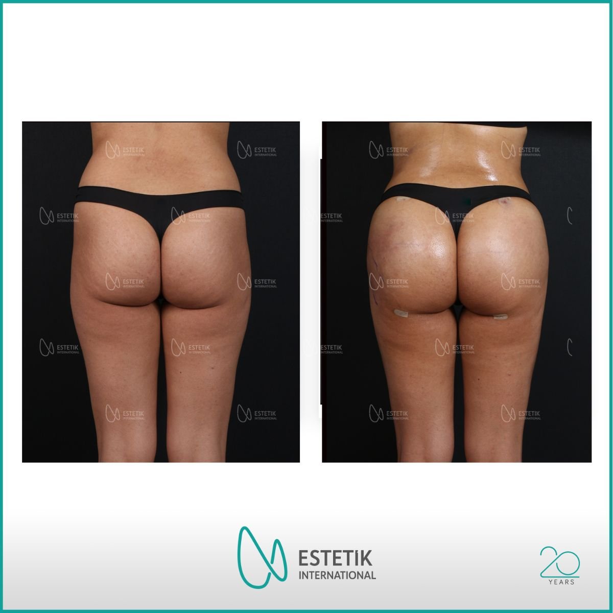Résultats avant et après Brazilian Butt Lift à Estetik International Istanbul, courbes améliorées