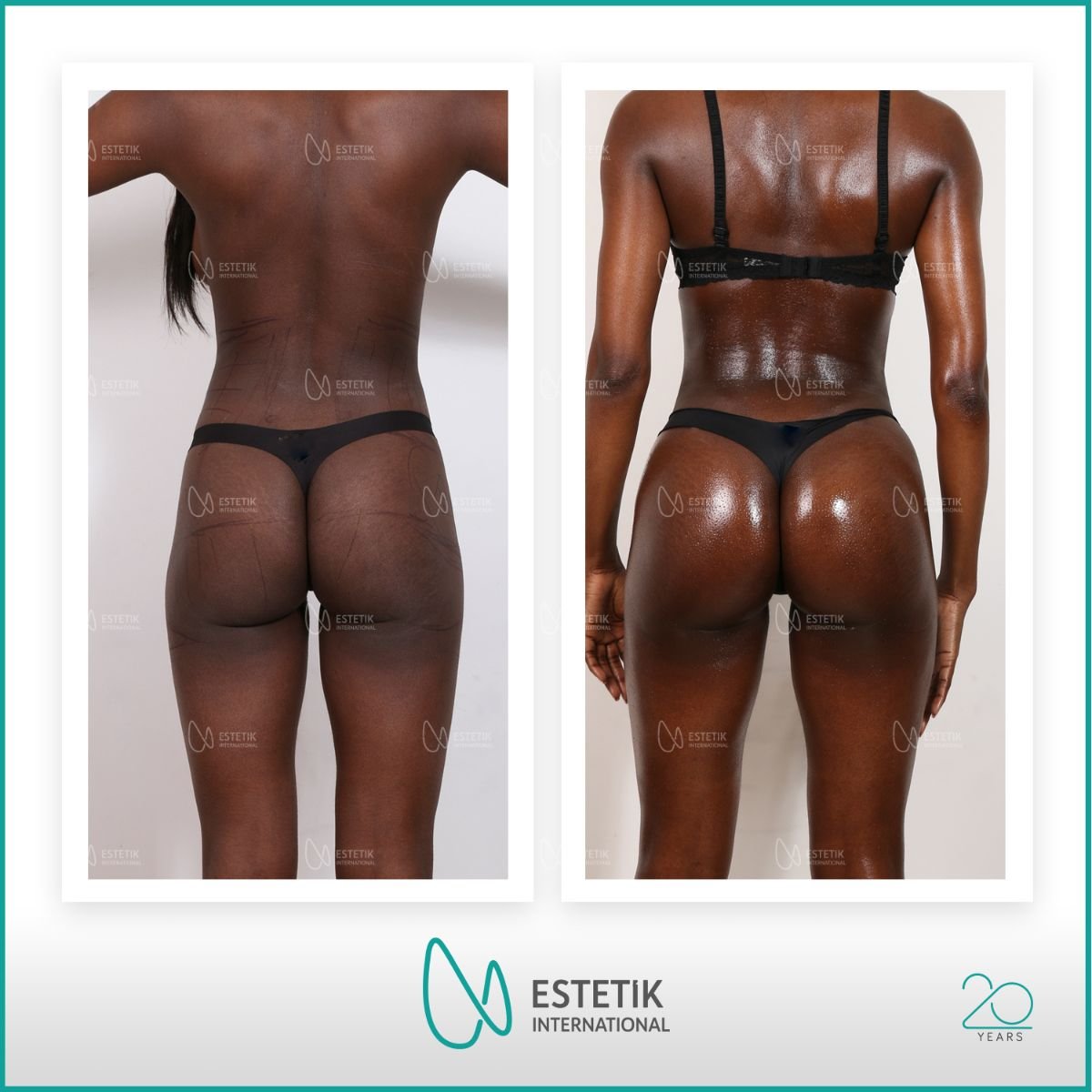 Vorher-nachher-Ergebnis Brazilian Butt Lift bei Estetik International Istanbul, verbesserte Kurven
