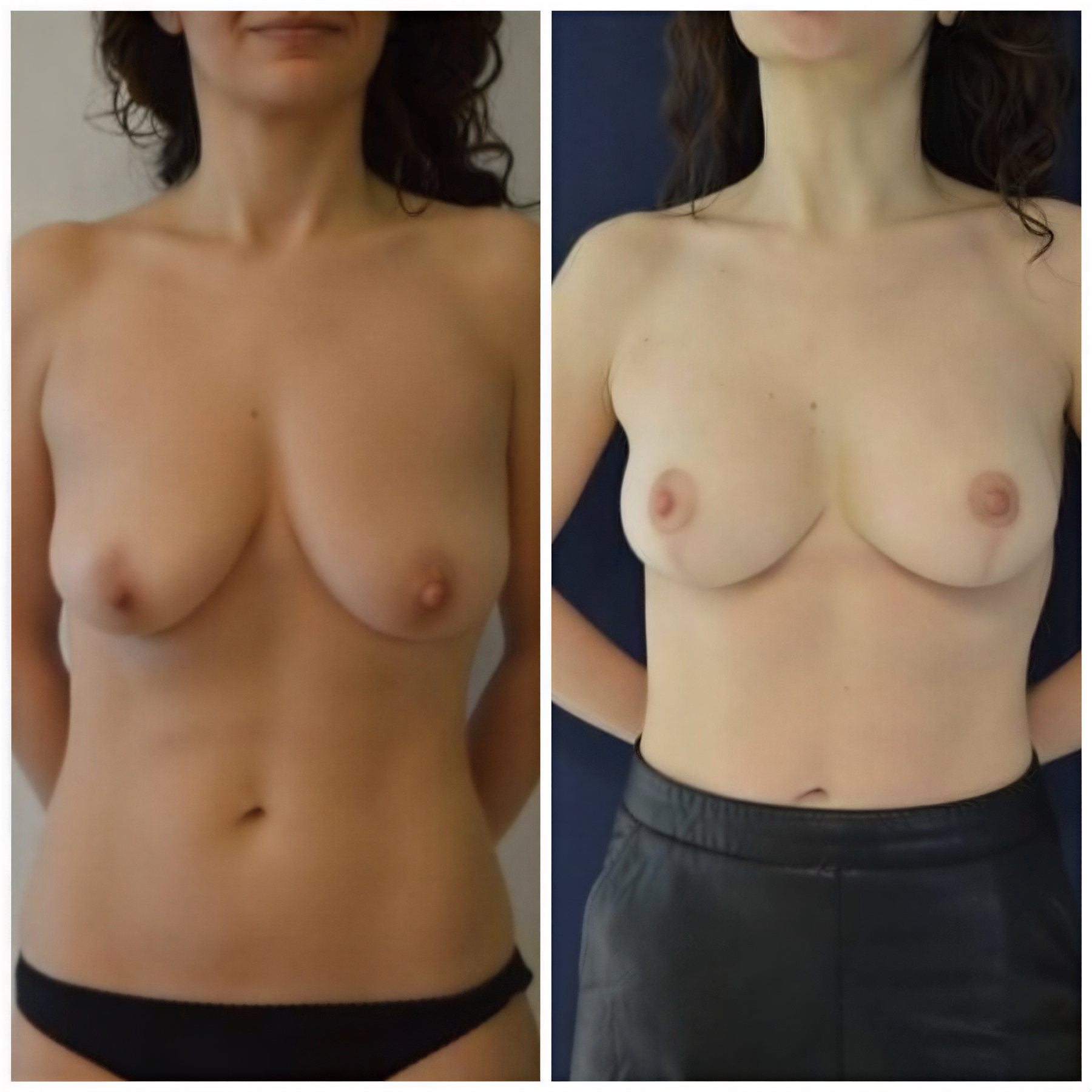 Resultados de mamoplastia antes y después en Istanbul Aesthetic Plastic Surgery Center, levantamiento de senos