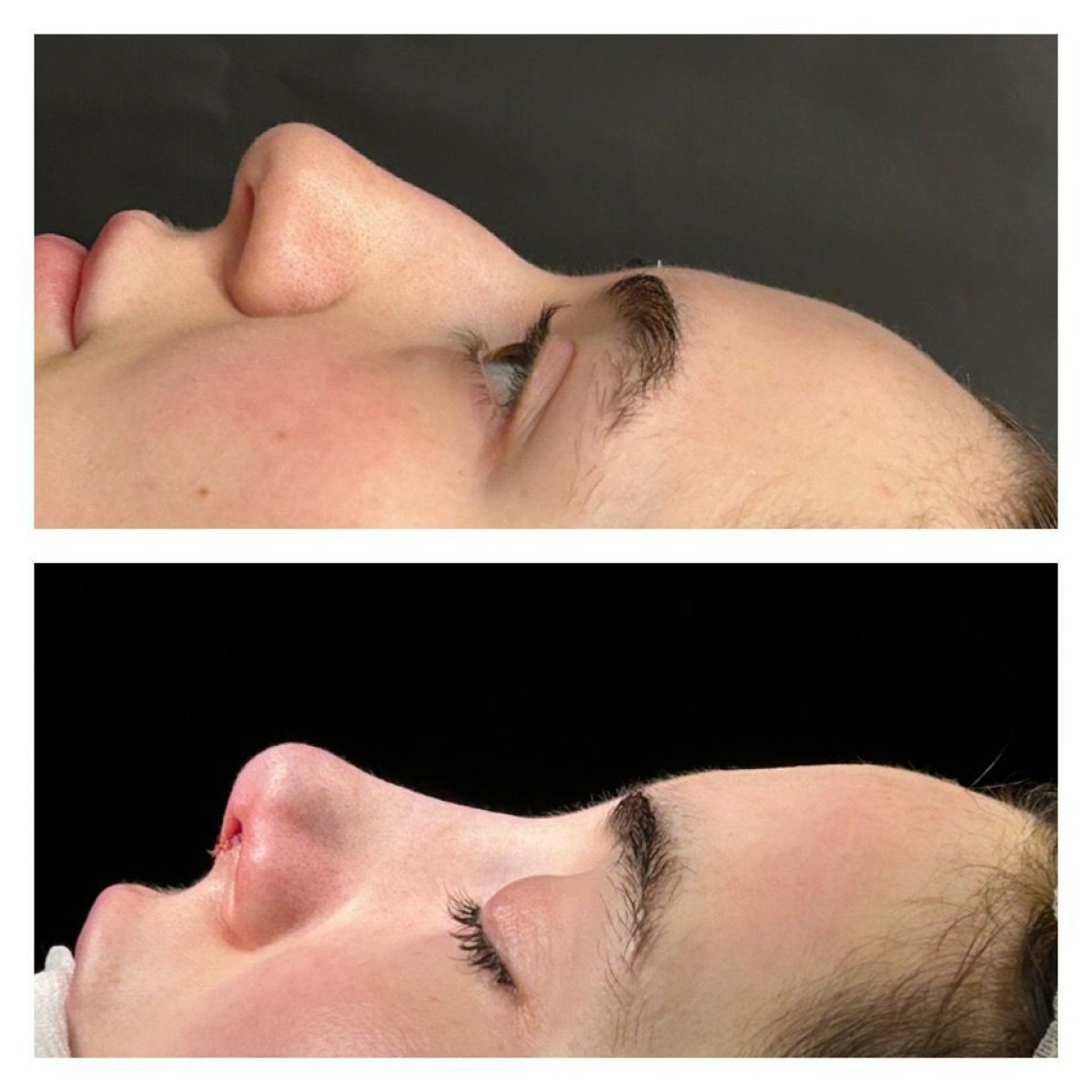 نتائج عملية تجميل الأنف قبل وبعد في مستشفى ميموريال شيشلي، تحسين شكل الأنف