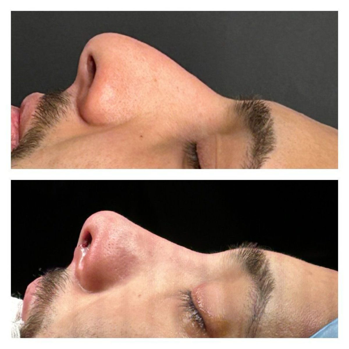 Before and after rhinoplasty results at Memorial Şişli Hospital, improved nose profile