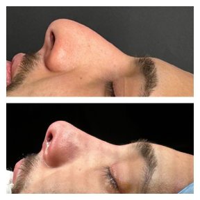 Standard Rhinoplasty (nose job) with All Included - photo 3