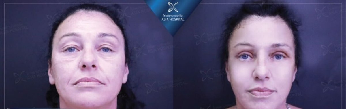 Resultados de feminización facial antes y después en Asia Cosmetic Hospital, rasgos suavizados