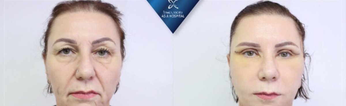 Resultados de cirugía de feminización facial antes y después en Asia Cosmetic Hospital, contornos mejorados