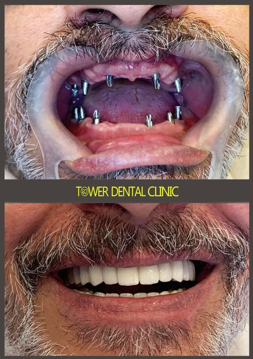 Resultados antes y después de implantes dentales en Tower Dental Clinic – sonrisa restaurada
