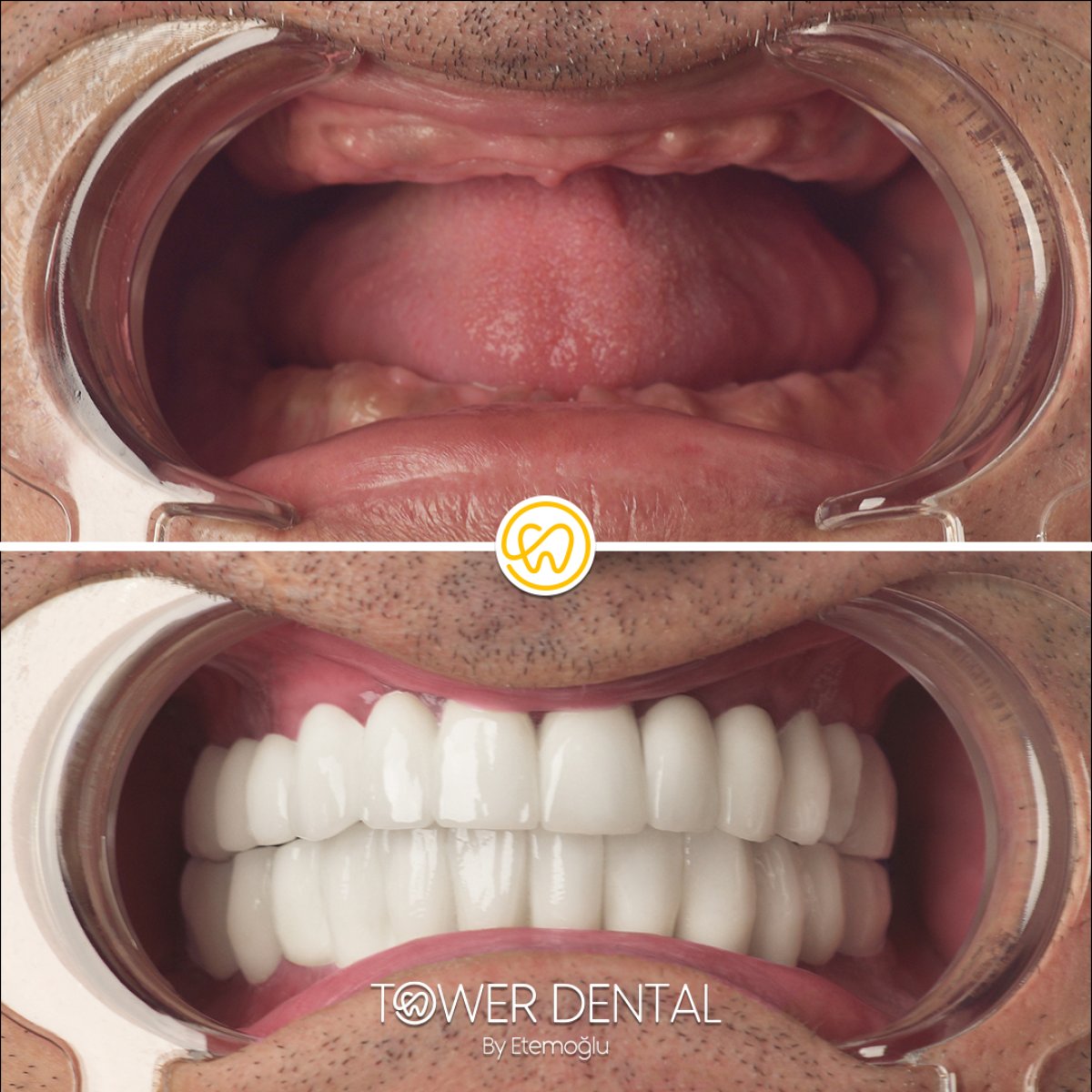 Before and after dental implant results at Tower Dental Clinic – full smile restoration