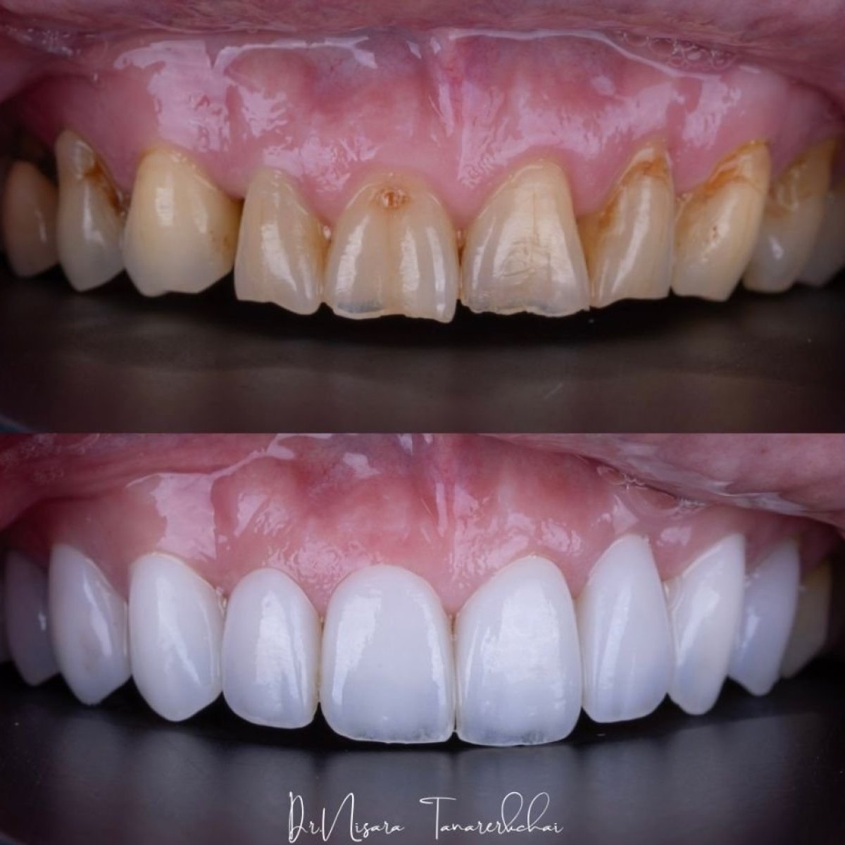 Before and after porcelain veneer results at About Tooth Dental Clinic, smile transformation
