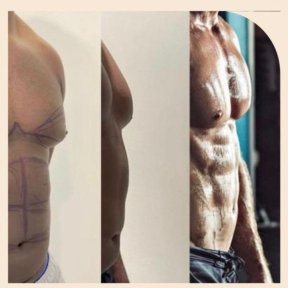 Total Body Liposuction & Liposculpture ALL INCUDED OFFER HD LIPOSCULPTURE - photo 2