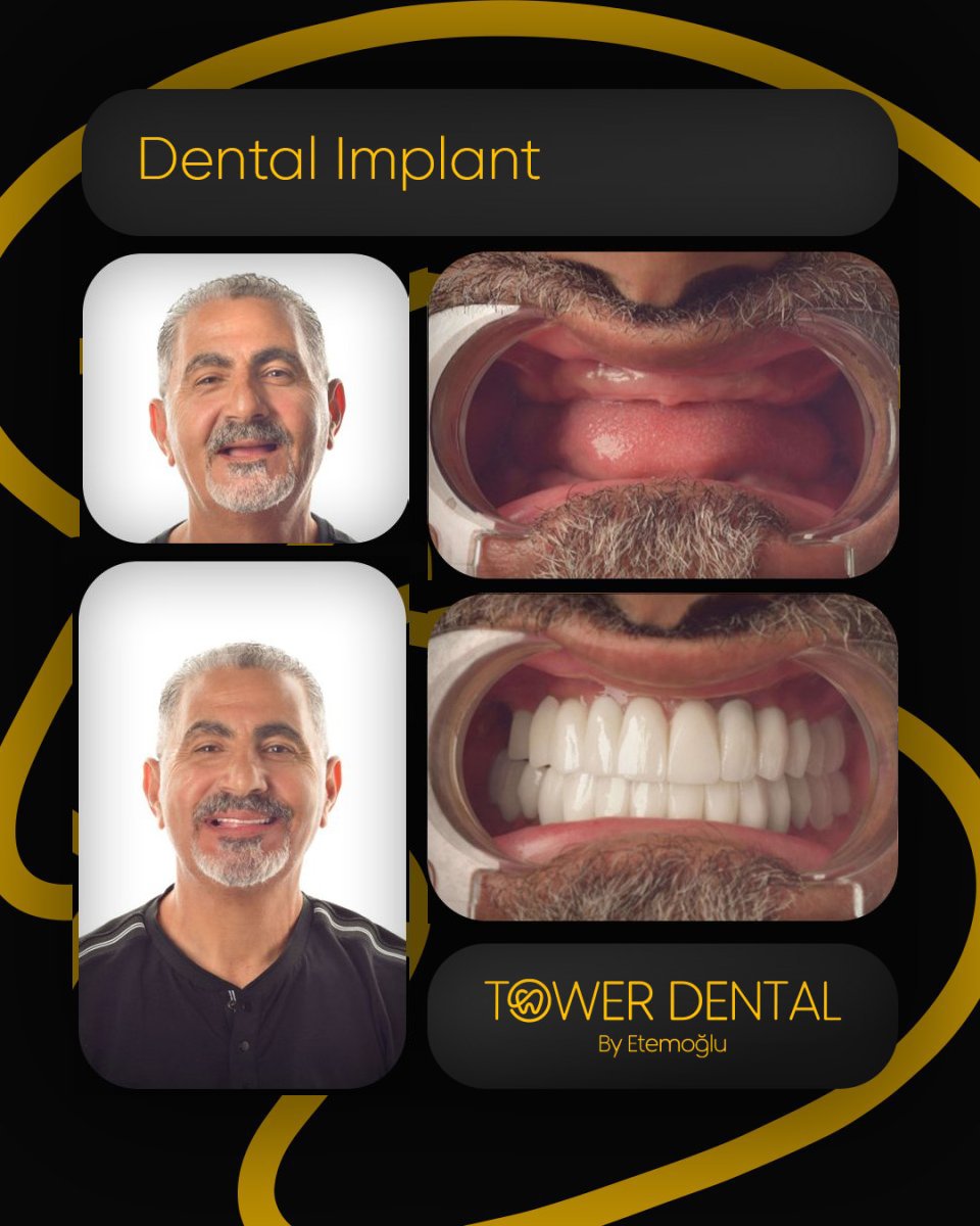 نتائج زراعة الأسنان قبل وبعد في Tower Dental Clinic – ابتسامة وأسنان مستعادة