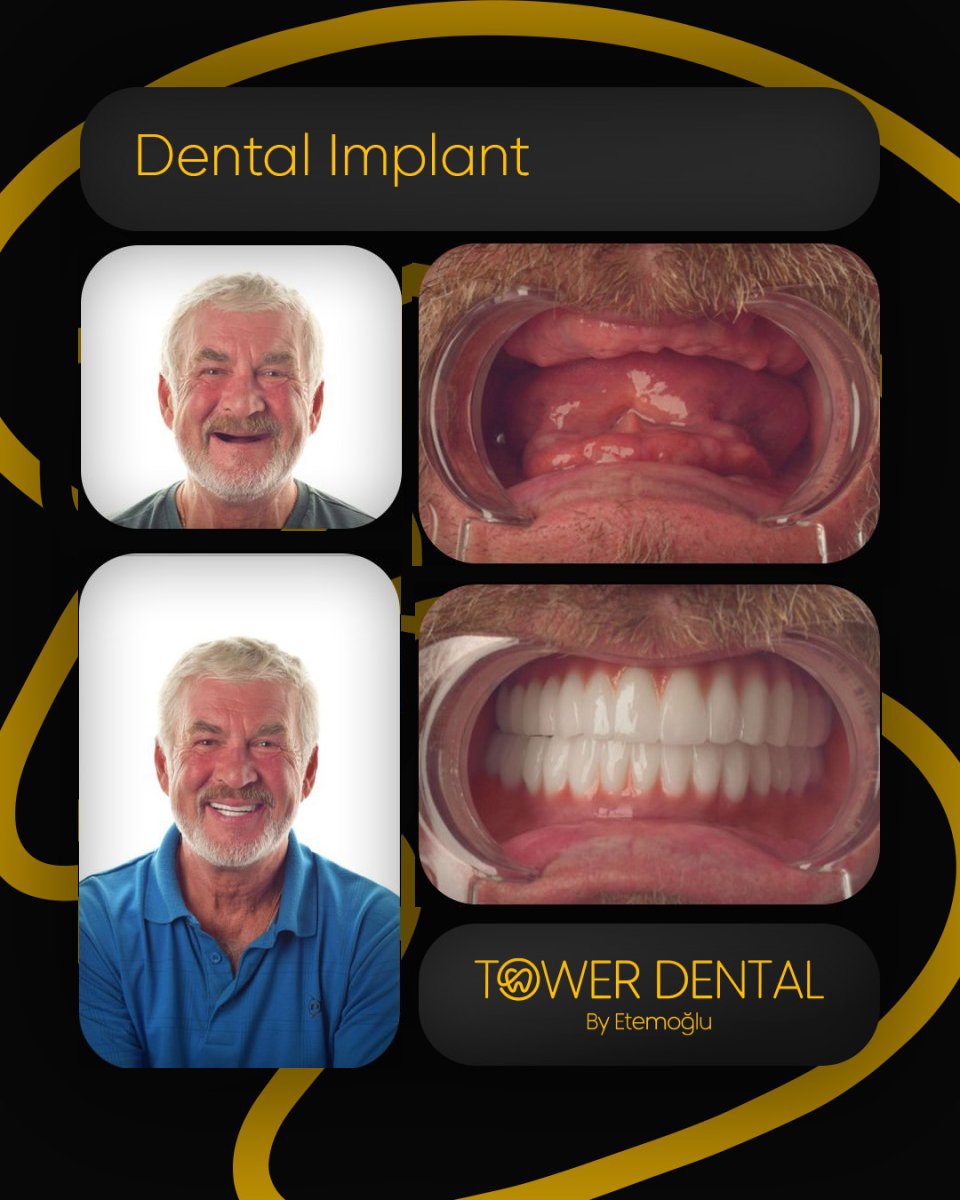 Resultados antes y después de implantes dentales en Tower Dental Clinic: sonrisa restaurada