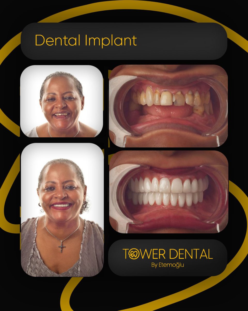 نتائج زراعة الأسنان قبل وبعد في Tower Dental Clinic – ابتسامة وأسنان مستعادة