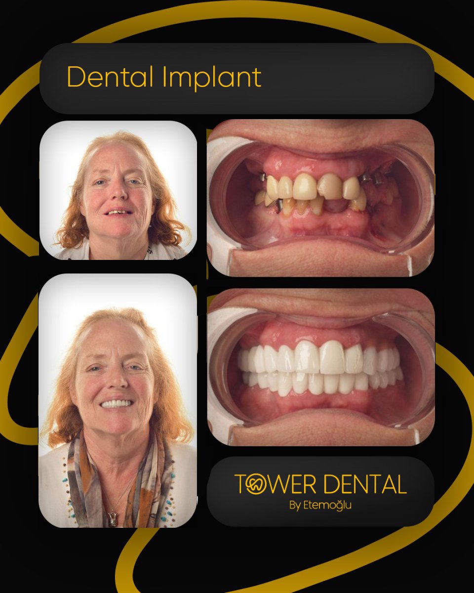 نتائج زراعة الأسنان قبل وبعد في Tower Dental Clinic – ابتسامة وأسنان مستعادة