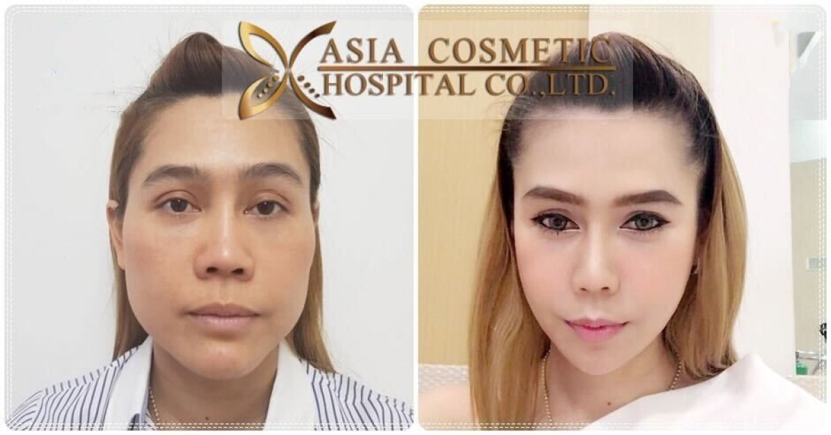 Facial feminization surgery before and after results at Asia Cosmetic Hospital, enhanced femininity