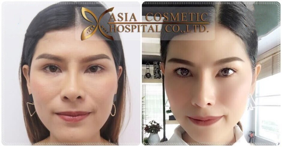 Facial feminization surgery before and after results at Asia Cosmetic Hospital, refined facial features